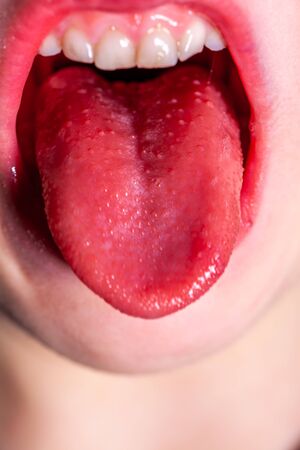 Tongue of a child with scarlet fever - strawberry tongueの写真素材