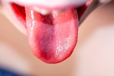 Tongue of a child with scarlet fever - strawberry tongueの写真素材
