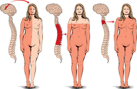 Head and spinal cord injuries paralysis some parts of the body.のイラスト素材