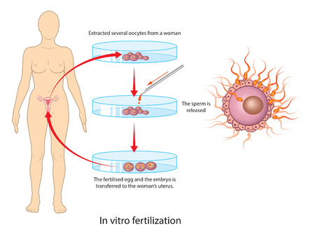In vitro fertilizationのイラスト素材