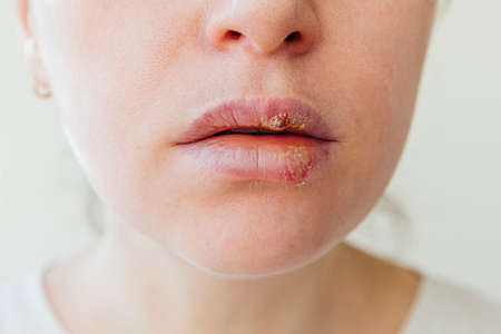 Close up of girl lips affected by herpes. Treatment of herpes infection and virus. Part of young woman face, lips with herpes affected. Beauty dermatology conceptの写真素材