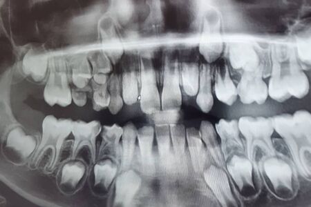 X-RAY PICTURE OF DAIRY AND NEW CHILDREN'S TEETH.の写真素材