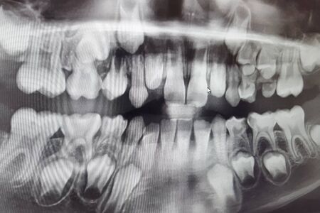 X-RAY PICTURE OF DAIRY AND NEW CHILDREN'S TEETH.の写真素材