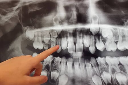 X-RAY PICTURE OF DAIRY AND NEW CHILDREN'S TEETH.の写真素材