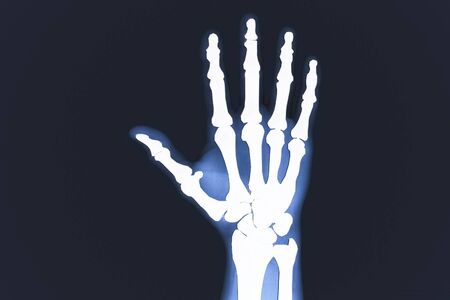 X-rayed human hand. X-ray of hand bonesの写真素材
