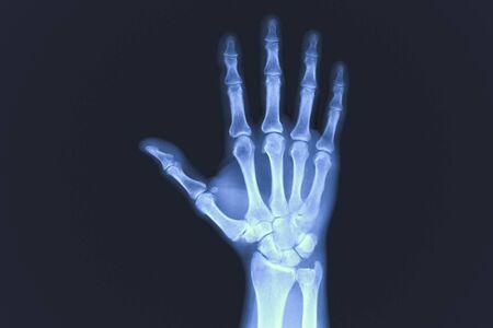 X-rayed human hand. X-ray of hand bonesの写真素材