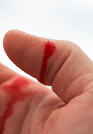  drop of blood on the incised wound on  finger.