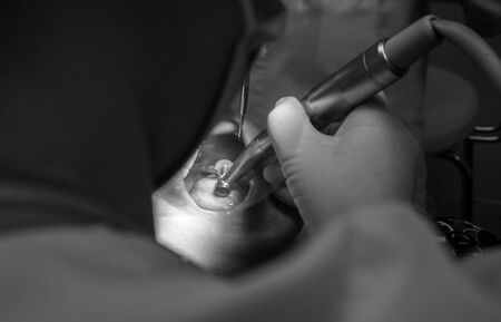 dentistry. dental treatment with caries at the dentist. close-up.