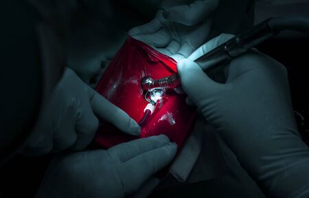 dentistry. dental treatment with caries at the dentist. close-up.の写真素材