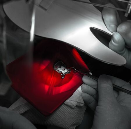 dentistry. dental treatment with caries at the dentist. close-up.
