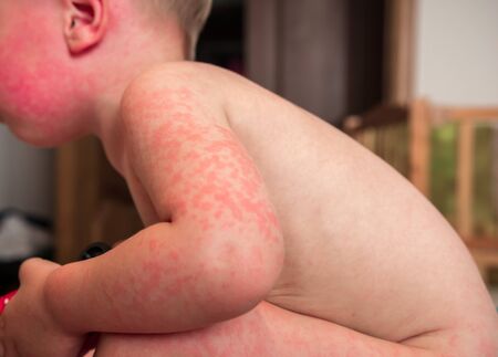 Allergies, pimples on the baby's skin. Food allergy. Skin diseases, symptoms.