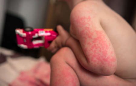 Allergies, pimples on the baby's skin. Food allergy. Skin diseases, symptoms.の写真素材