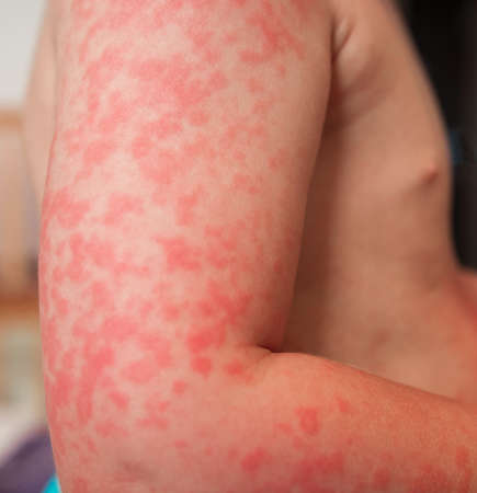 Allergies, pimples on the baby's skin. Food allergy. Skin diseases, symptoms.の写真素材