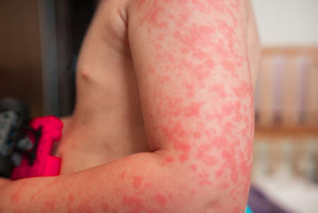 Allergies, pimples on the baby's skin. Food allergy. Skin diseases, symptoms.の写真素材