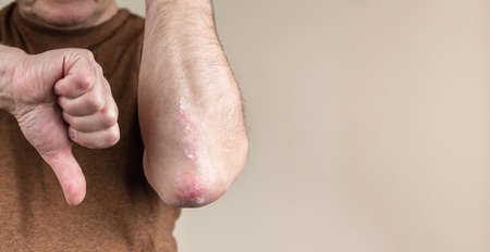 Failed psoriasis treatment. A man shows his thumb up next to the elbow for psoriasis. it was not possible to cure a skin diseaseの写真素材