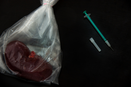 medication cure Diabetic Nephropathy. treatment of diabetes mellitus to slow, avoid renal failure. Transplantation or dialysis as a decision to refuse treatment. kidney, insulin syringe on dark.の写真素材