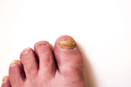 Onychomycosis is a fungal infection of the nail. Mycosis of the foot. Foot with affected nails on a white background close-up. Scary toenails.の写真素材