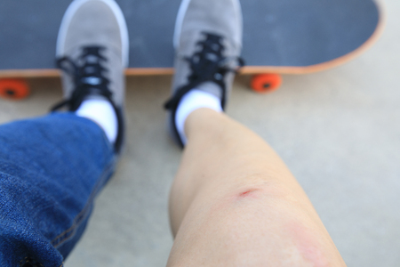skateboarder injured legs while skateboarding on skatepark rampの写真素材