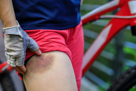 People with bruised leg casused by bike accidentの写真素材
