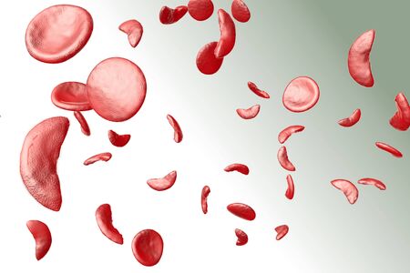 Sickle cell anemia disease (SCD) blood cells 3D illustrationの写真素材