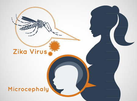 Microcephaly or Abnormal Smallness of the Head Concept. The Zika Fever Virus is linked to microcephaly birth defect cases from pregnant women bitten by Aedes aegypti mosquitoes.のイラスト素材