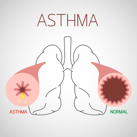 Asthma vector icon illustrationのイラスト素材
