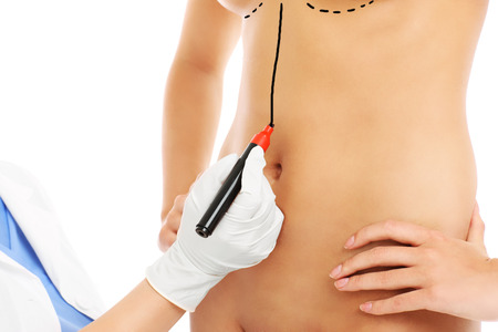 A picture of a doctor marking belly for surgeryの写真素材