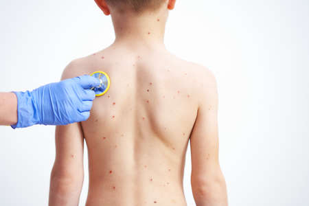 Young boy having chickenpox pictures of skin