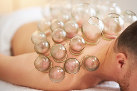 A picture of a man having cupping therapyの写真素材