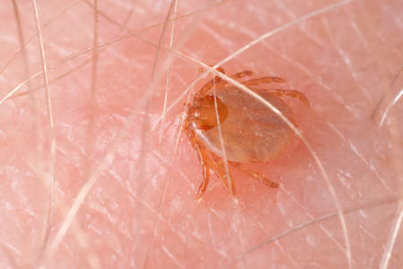 Tick drinking blood biting human skin
