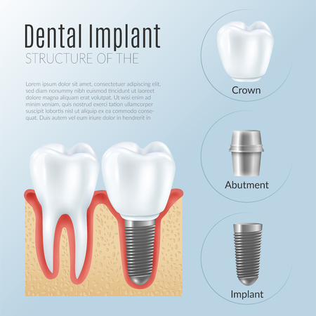 Structure of dental prosthetics infographics poster with denture near healthy tooth crown abutment implant realistic icons vector illustrationのイラスト素材
