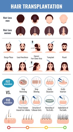 Baldness of men and women methods of hair transplantation set with infographic elements isolated vector illustrationのイラスト素材