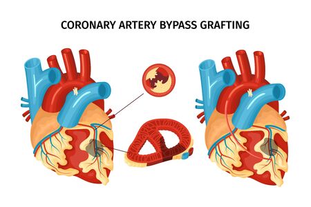 Anatomy of heart with coronary artery bypass grafting flat vector illustrationのイラスト素材