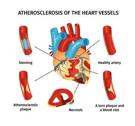 Atherosclerosis of heart vessels flat infographics with labeled parts vector illustrationのイラスト素材