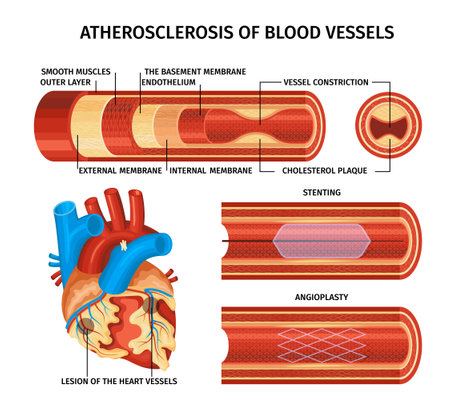 Realistic Atherosclerosis Infographicのイラスト素材