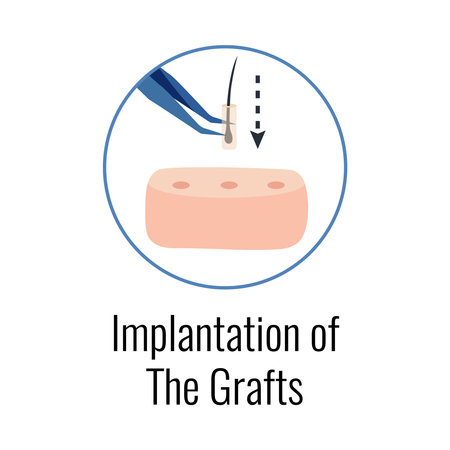 Alopecia Grafts Implantation Compositionのイラスト素材
