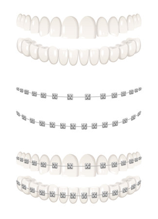 Teeth Braces Setのイラスト素材