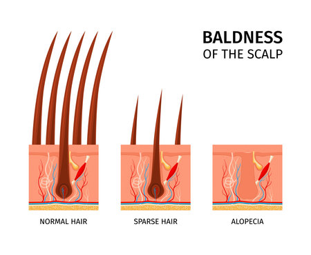 Scalp Baldness Structure Compositionのイラスト素材