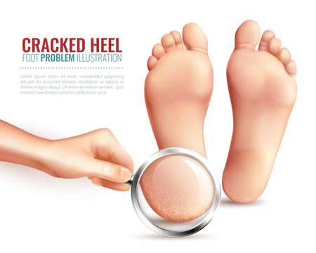 Female hand with magnifier near feet, zoom of cracked heels on white background vector illustrationのイラスト素材