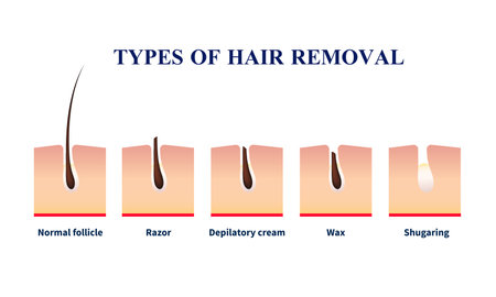 Normal follicle and types of hair removal with help of razor, depilation cream, wax, sugaring vector illustrationのイラスト素材
