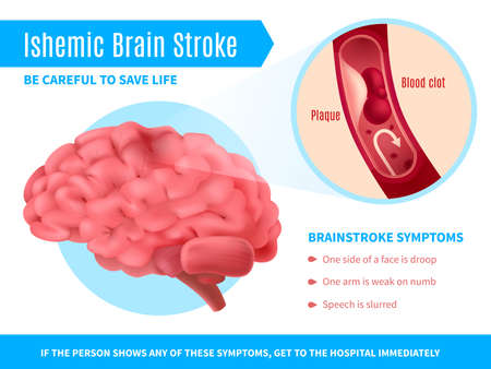 Ischemic brain stroke realistic poster with symptoms list and call to be careful to save life vector illustrationのイラスト素材