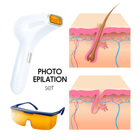 Photo epilation realistic set with epilator protective goggles and cross section of skin layers scheme vector illustrationのイラスト素材