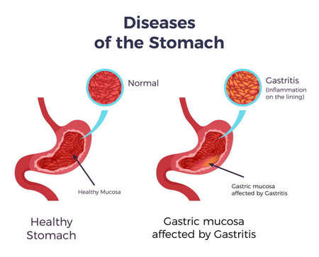 Human normal stomach compared to gastritis affected swollen inflamed mucosa lining flat set infographic poster vector illustrationのイラスト素材
