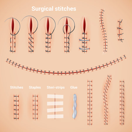 Surgical suture stitches realistic set of stitching methods and shapes with staples glue and text captions vector illustrationのイラスト素材