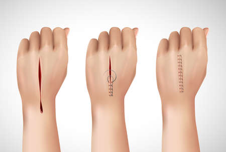 Surgical suture stitches realistic composition with isolated images of human hand at different stages of stitching vector illustrationのイラスト素材