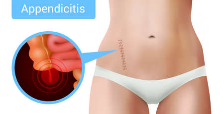 Surgical suture stitches realistic appendicitis composition with view of surgical intervention mark on realistic female body vector illustrationのイラスト素材