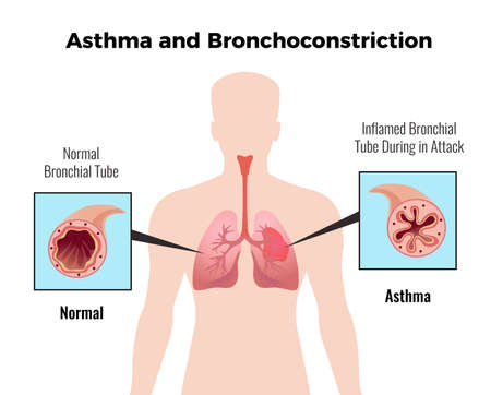 Asthma attack medical educative chart poster with depiction of normal and inflamed bronchial tube flat vector illustrationのイラスト素材