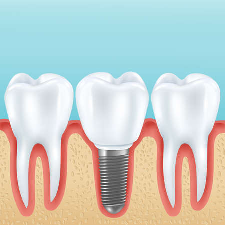 Dental prosthetics realistic vector illustration with healthy teeth and denture crown implanted with implantsのイラスト素材