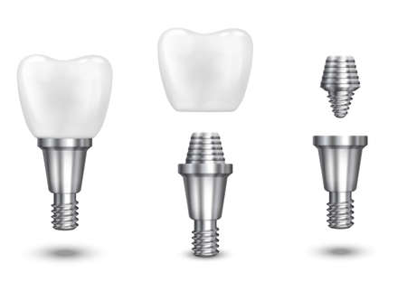 Tooth implant. Implant dental and health tooth, healthy implant, vector illustrationのイラスト素材