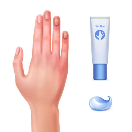 Vector illustration of injured hand and tube gel for bruises with drop of cream and on white backgroundのイラスト素材
